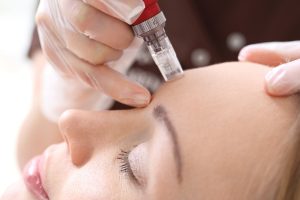 microneedling east london - Microneedle mesotherapy