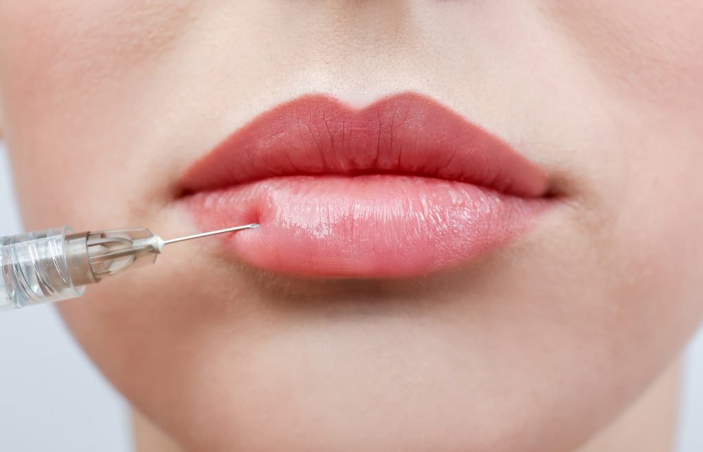 lip fillers east london - woman receiving filler injection in lips